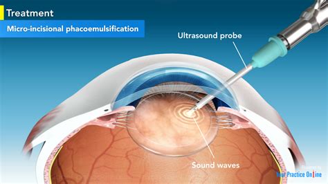 Phacoemulsification Cataract Surgery In Chennai Amrit, 43% OFF