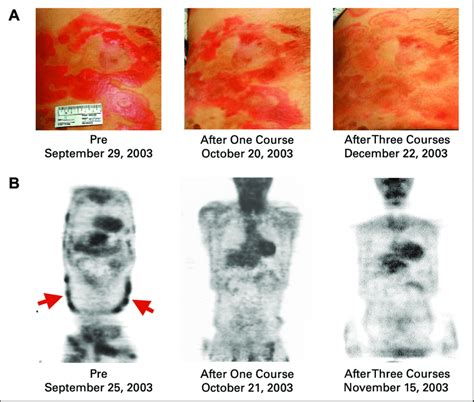 Cutaneous T-cell lymphoma. (A) Photographs of skin lesions on the days... | Download Scientific ...