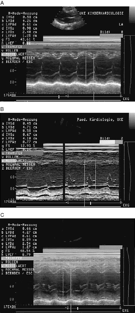 (a) Preoperative echocardiography. Parasternal long‐axis view. M‐mode... | Download Scientific ...