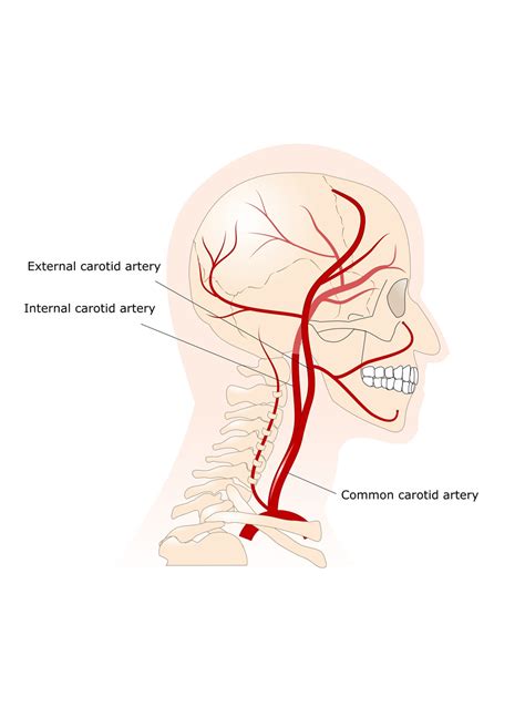 Carotid Arteries | Eye Patient