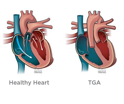 Transposition of the Great Arteries | Cardinal Glennon