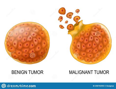 Neoplasm And Cancer. Malignant And Benign Tumor Cartoon Vector ...