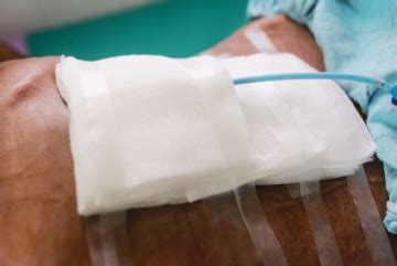 Wound Exudate Assessment and Management Strategies | WoundSource