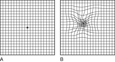 amsler grid pdf aao - Shag Weblogs Photographic Exhibit