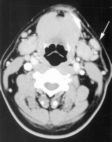 Neck metastasis presenting as extracapsular spread in a normal-sized... | Download Scientific ...