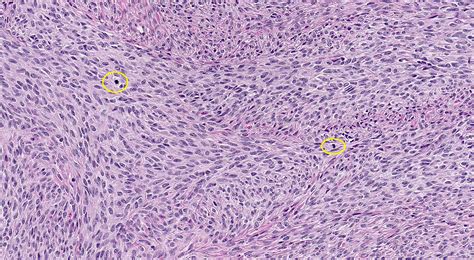 Fibroma Histology