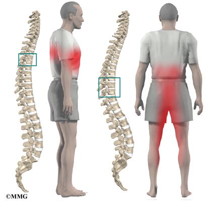 Thoracic Disc Herniation | eOrthopod.com