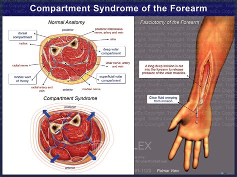 Compartment Syndrome of the Forearm - TrialQuest Inc.