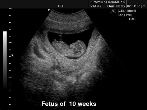 What can I expect to see in my 10 week ultrasound?! - BabyCenter