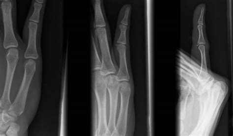 Volar Plate Fracture - radRounds Radiology Network