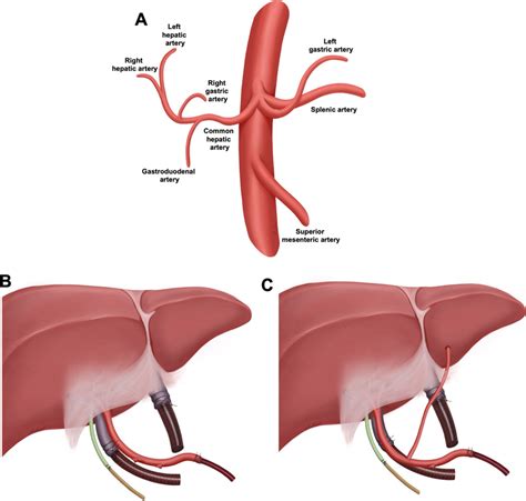 Regular anatomy of the celiac trunk and cannulation for normothermic ...