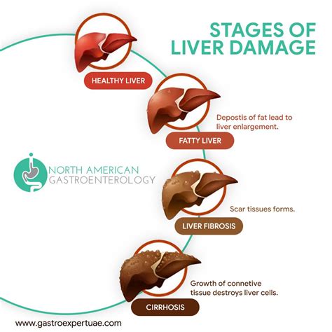 Stages of Liver Damage | Liver health, Healthy liver, Medical anatomy