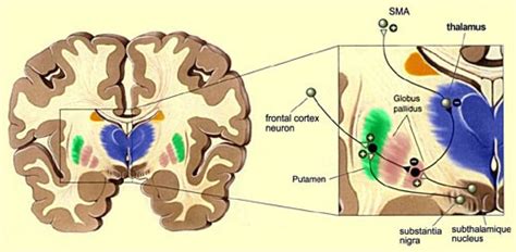 Anti-NMDA Receptor Encephalitis : Treatment, outcome, and relapses