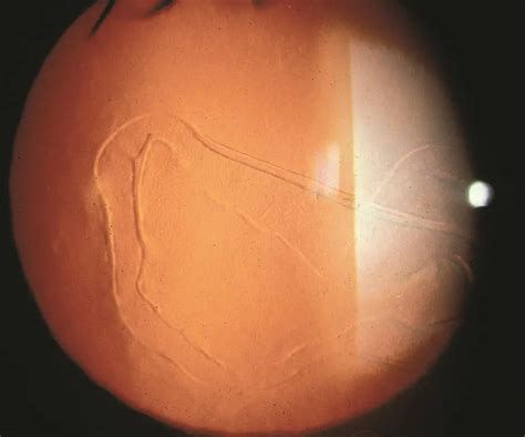 Haab's striae - American Academy of Ophthalmology