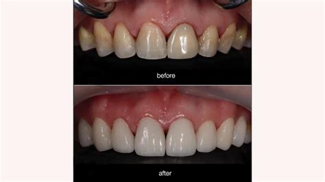 Composite Veneers Pros & Cons, Procedure, Cost, and Alternatives ...