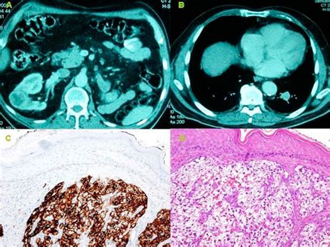 Cutaneous metastases in renal cell carcinoma: a case report | Cases Journal | Full Text