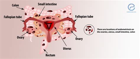 Atypical Sites of Deeply Infiltrative Endometriosis | EndoNews