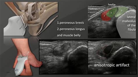 Webinar: Ultrasound Basics of the Foot and Ankle with Injections - YouTube