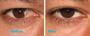 Pterygium Treatment & Recovery | Pterygium Eye Surgery