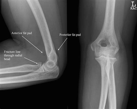 RADIAL HEAD FRACTURES | ACE Physical Therapy and Sports Medicine Institute