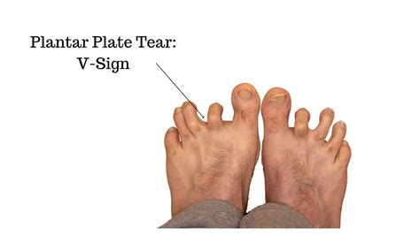 Plantar Plate Tear: Symptoms, Causes and Treatment