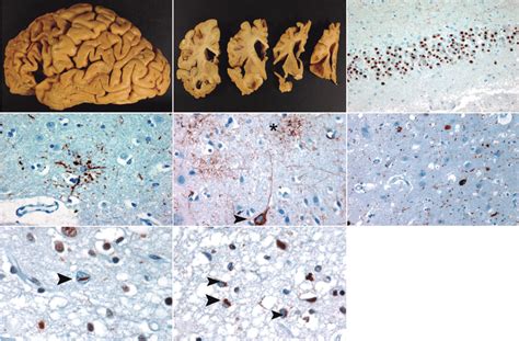 [A and B] Typical frontotemporal atrophy in a case of Pick's disease ...