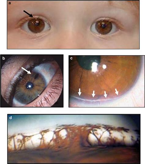 Ocular changes observed in Axenfeld–Rieger syndrome. (a) Corectopia on ...