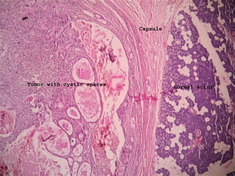 PLEOMORPHIC ADENOMA – Histopathology.guru