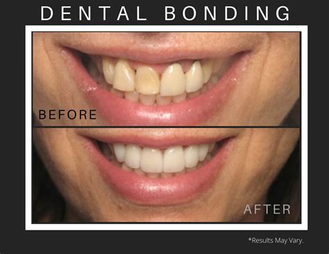 Filling the Gaps: Veneers, Implants and Dental Bonding | Dr. Kevin Sands