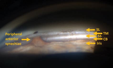 Gonioscopy: A Simple Tool, Too Often Forgotten