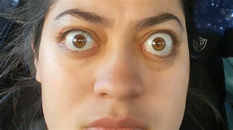 A woman with bulging eyes from grave’s disease undergoes a remarkable ...