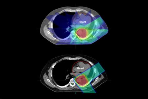 Proton therapy as effective as standard radiation with fewer side ...