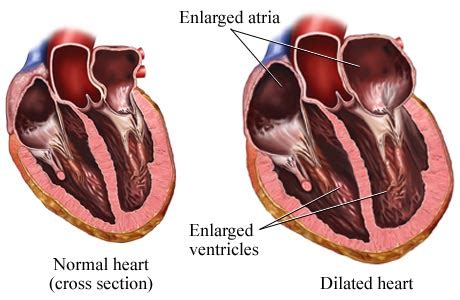 Hypertensive Heart Disease – Symptoms, Treatment, Causes