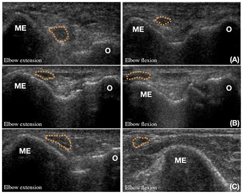 Ulnar Nerve Ultrasound