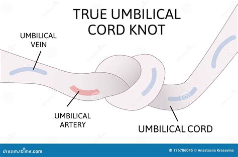 True Umbilical Cord Knot. Umbilical Cord Forms a Knot Inside the Womb ...