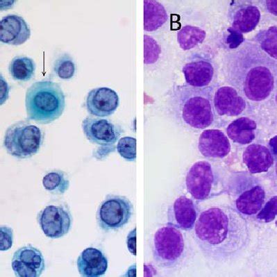 Metastatic lung adenocarcinoma in a pleural effusion specimen. The ...