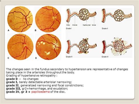 Grading In Ophthalmology - Eye Health Nepal