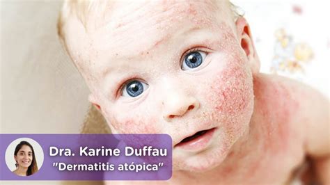 Dermatitis atópica infantil: el tratamiento a seguir - mediQuo