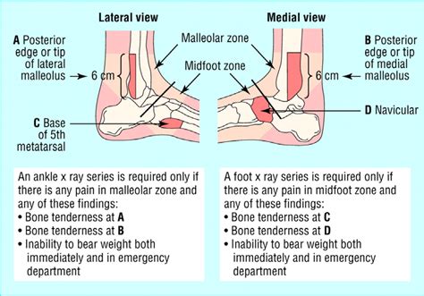 Ottawa Ankle Rules 47 | Download Scientific Diagram