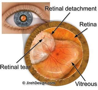 Lattice degeneration causes, treatments and surgery