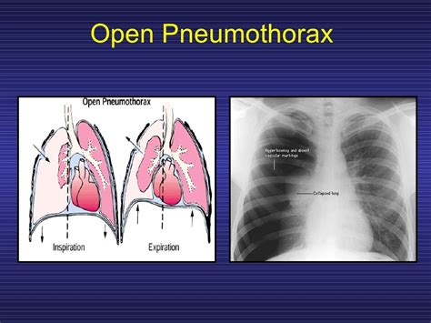 Treating Penetrating Chest Trauma