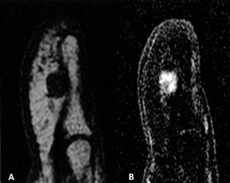 Glomus Tumor Mri