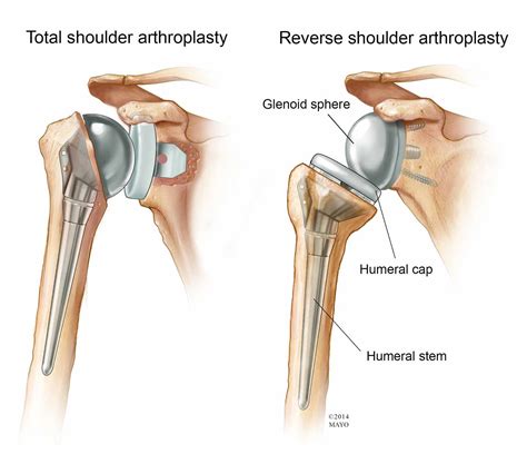 Tuesday Q and A: Reverse shoulder arthroplasty may be best option for ...