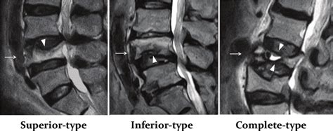 Preoperative MRI images showing the three types of burst fracture ...