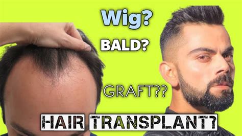 Virat Kohli Hair Transplant Result | Virat Hairfall | Hair loss ...