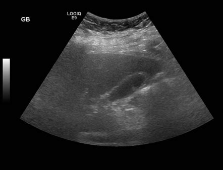 Gallbladder polyp | Radiology Case | Radiopaedia.org
