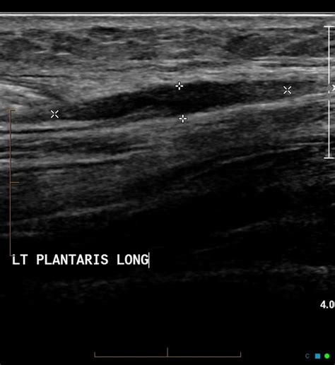 SplintER: An Pop in the Calf Caused by Plantaris Rupture