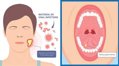 7 Things That Cause Salivary Stones (And How to Prevent Them)