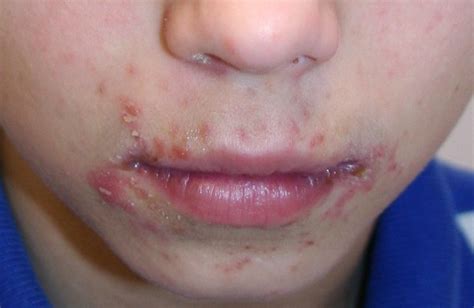 Impetigo | work | Pinterest