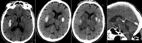 Radiology MRI: Deep Cerebral Venous Sinus Thrombosis with External ...